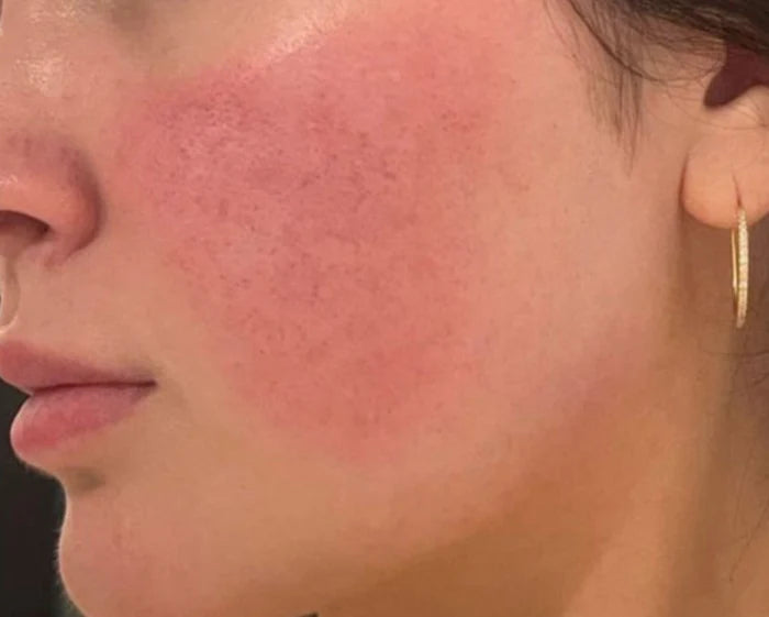 Rosacea Regimen Box